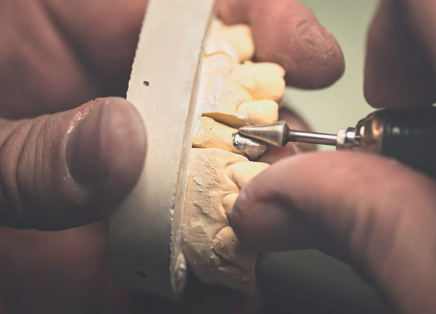 Implantatgetragene Arbeit im Dentallabor